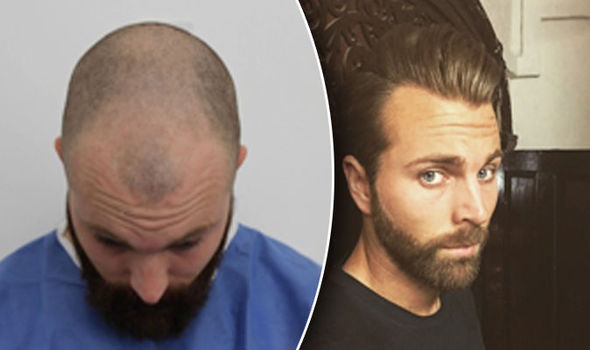 Best Hair Transplant Dubai - FUT & FUE Hair Transplant